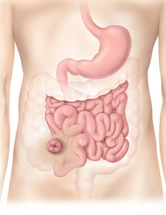 ileostomy