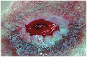 Pseudoverrucous Lesions