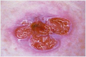 Pyoderma Gangrenosum