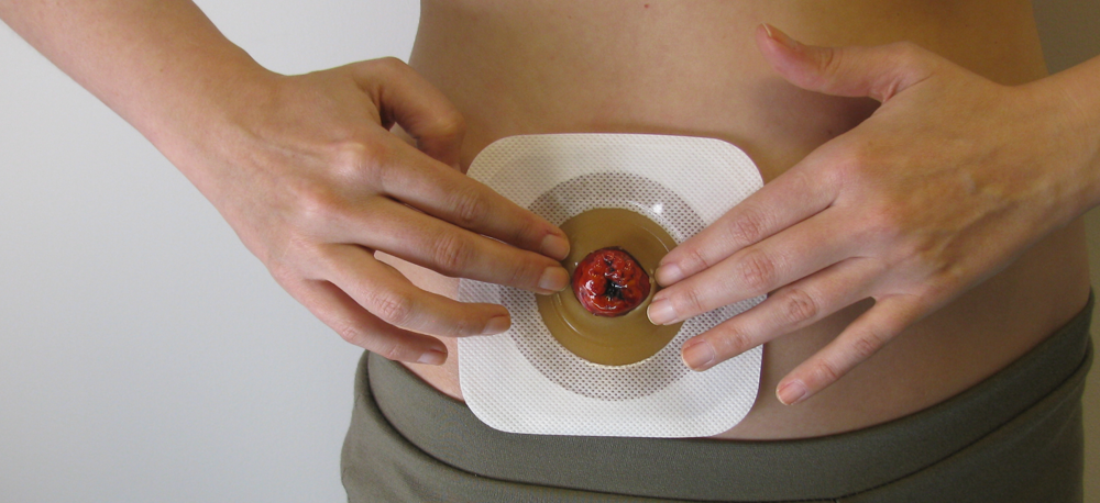 ConvaTec Esteem Synergy Versorgungswechsel Schritt f&uuml;r Schritt 05