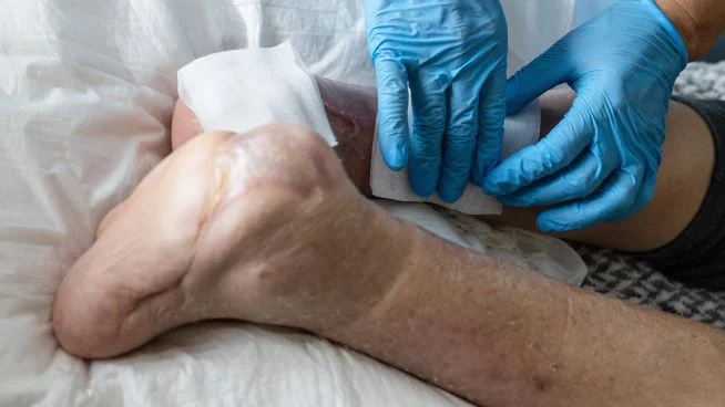 Zwei Hände in blauen Handschuhen legen Wundauflagen an amputierten Füßen an. 