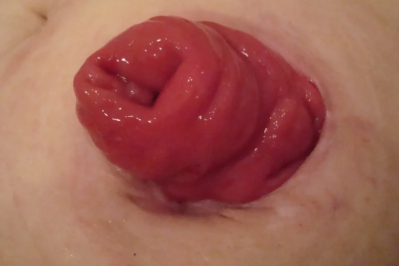 Stomia prawidłowa z uwypukloną śluzówką